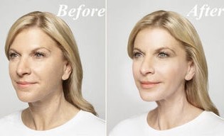 Before and after using the Cream, Goji