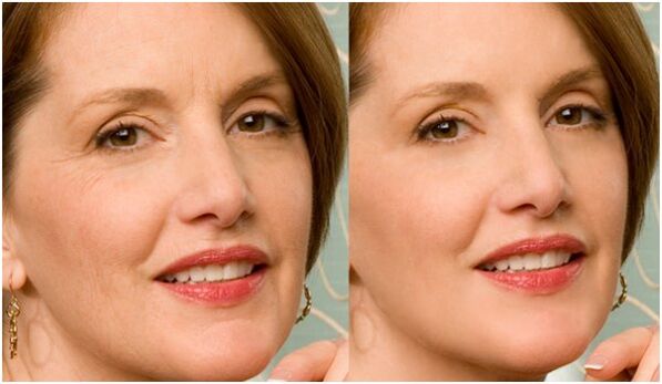 before and after the rejuvenation of facial skin in plasma