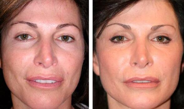 photo before the rejuvenation of facial skin in plasma