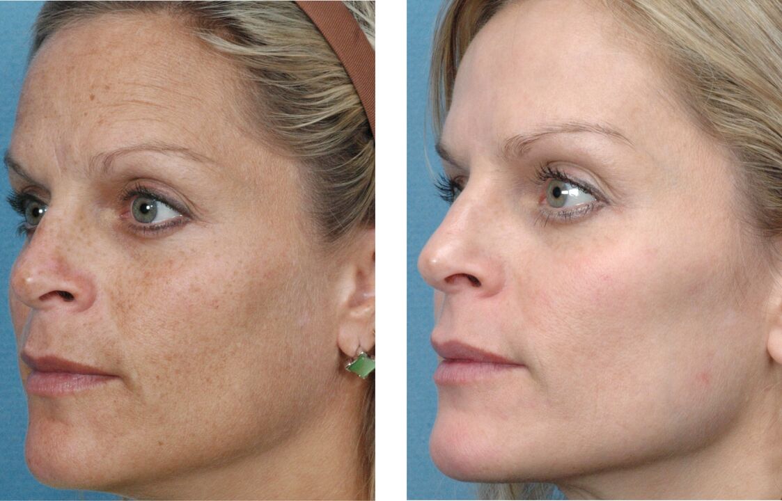 photo before and after skin rejuvenation 1