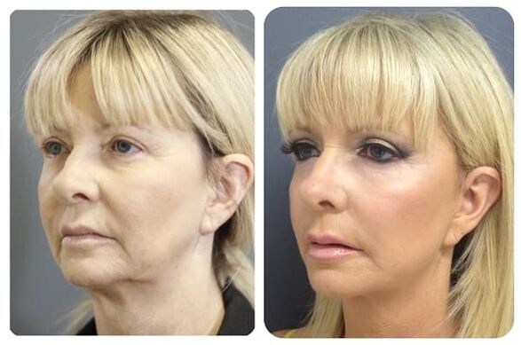 before and after skin rejuvenation with firming photo 2