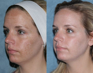 Before and after the fractional rejuvenation of the face