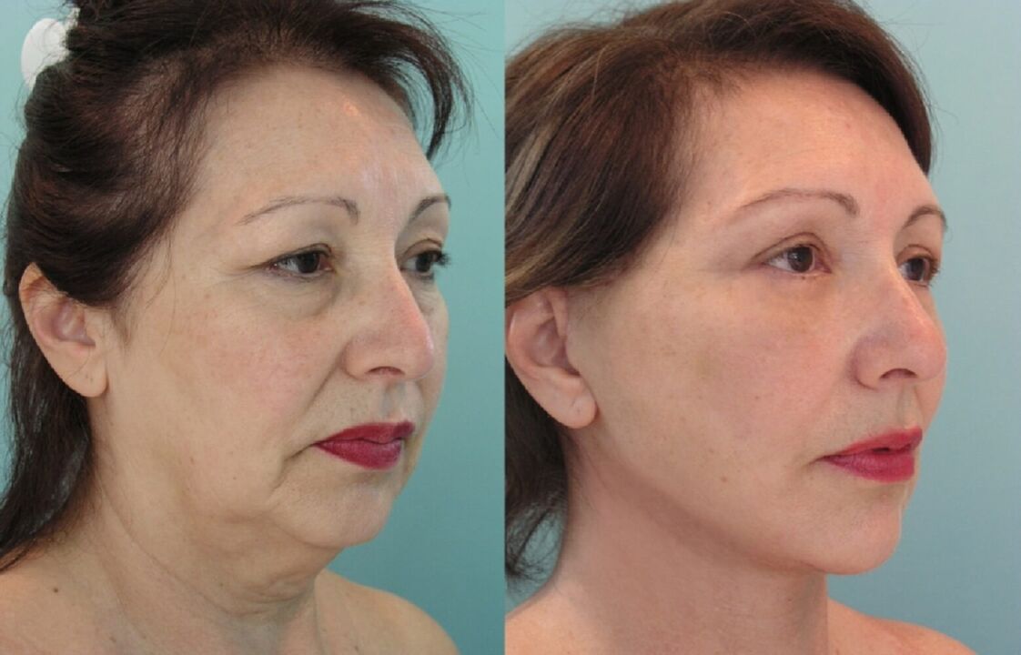 Before and after the facelift with threads