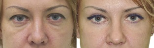 Photos before and after the contour of the eyelids