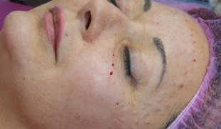 skin rejuvenation after mesotherapy
